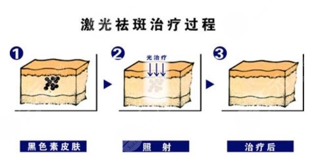 激光祛斑